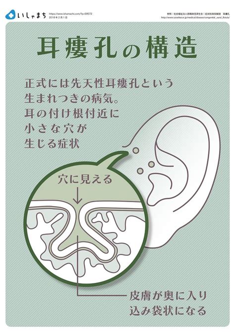 穴汁|耳瘻孔・先天性耳瘻孔とは……腫れ・臭いがあれば手。